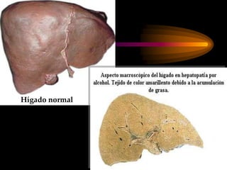 Hígado normal
 