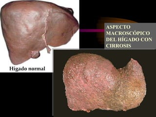 Hígado normal
ASPECTO
MACROSCÓPICO
DEL HÍGADO CON
CIRROSIS
 