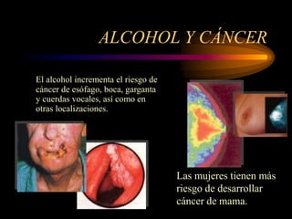 ALCOHOL Y CÁNCER
El alcohol incrementa el riesgo de
cáncer de esófago, boca, garganta
y cuerdas vocales, así como en
otras localizaciones.
Las mujeres tienen más
riesgo de desarrollar
cáncer de mama.
 