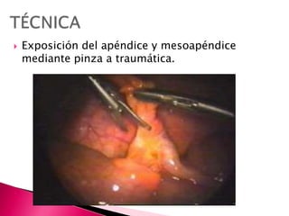  Exposición del apéndice y mesoapéndice
mediante pinza a traumática.
 