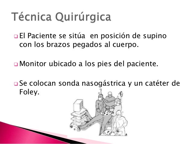 tecnica apendicectomia