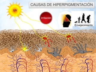 13 1 
3 
UV 
Envejecimiento 
CAUSAS DE HIPERPIGMENTACIÓN 
Irritación  