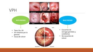 VPH
ALTO RIESGO BAJO RIESGO
• Tipos 16 y 18
• Sin síntomas por lo
general.
• Causa de cáncer
• Causantes de
verrugas genitales y
condilomas
• No causantes de
cáncer
 