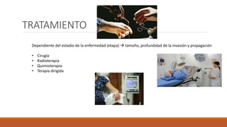 TRATAMIENTO
Dependiente del estadio de la enfermedad (etapa)  tamaño, profundidad de la invasión y propagación
• Cirugía
• Radioterapia
• Quimioterapia
• Terapia dirigida
 