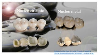 Prótesis Dental Libre de metal Zirconio | IMAGEN
DENTALimagendentalmcbo.wordpress.com1241 × 661
 