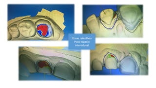 Zonas retentivas
Poco espacio
interoclusal
 