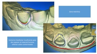 Zona retentiva
Contorno Vestibular insuficiente para
dar espesor al material.Coronas
salieron sobre contorneadas
 