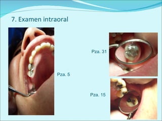 7. Examen intraoral Pza. 31 Pza. 15 Pza. 5 