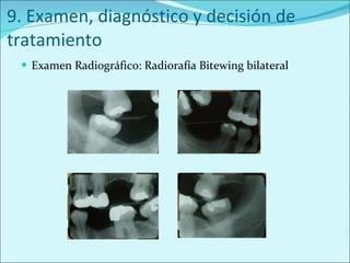 9. Examen, diagnóstico y decisión de tratamiento Examen Radiográfico: Radiorafía Bitewing bilateral 