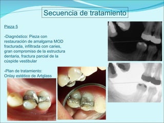 Secuencia de tratamiento Pieza 5 -Diagnóstico: Pieza con restauración de amalgama MOD fracturada, infiltrada con caries, gran compromiso de la estructura dentaria, fractura parcial de la cúspide vestibular -Plan de tratamiento:  Onlay estético de Artglass 