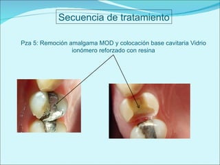 Secuencia de tratamiento Pza 5: Remoción amalgama MOD y colocación base cavitaria Vidrio ionómero reforzado con resina 
