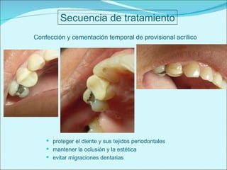 Secuencia de tratamiento Confección y cementación temporal de provisional acrílico proteger el diente y sus tejidos periodontales mantener la oclusión y la estética evitar migraciones dentarias 