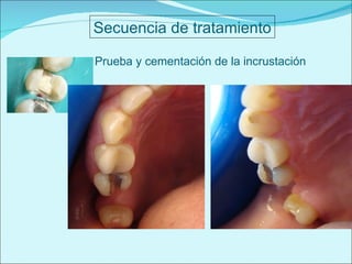 Secuencia de tratamiento Prueba y cementación de la incrustación 