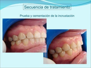 Secuencia de tratamiento Prueba y cementación de la incrustación 
