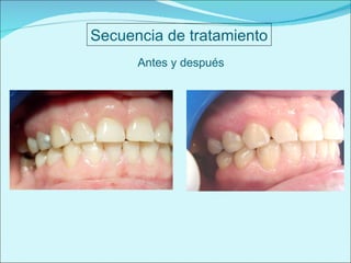 Antes y después Secuencia de tratamiento 