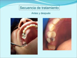 Antes y después Secuencia de tratamiento 