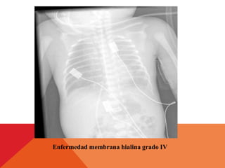 Enfermedad membrana hialina grado IV
 
