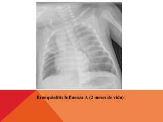 Bronquiolitis Influenza A (2 meses de vida)
 