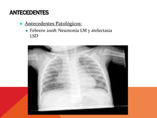 ANTECEDENTES
● Antecedentes Patológicos:
● Febrero 2008: Neumonía LM y atelectasia
LSD
 