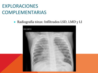 EXPLORACIONES
COMPLEMENTARIAS
● Radiografía tórax: Infiltrados LSD, LMD y LI
 