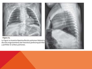 La Figura 1a muestra hiperinsuflación pulmonar bilateral y
discreto engrosamiento del intersticio peribronquial hiliar
y perihiliar en ambos pulmones.
 