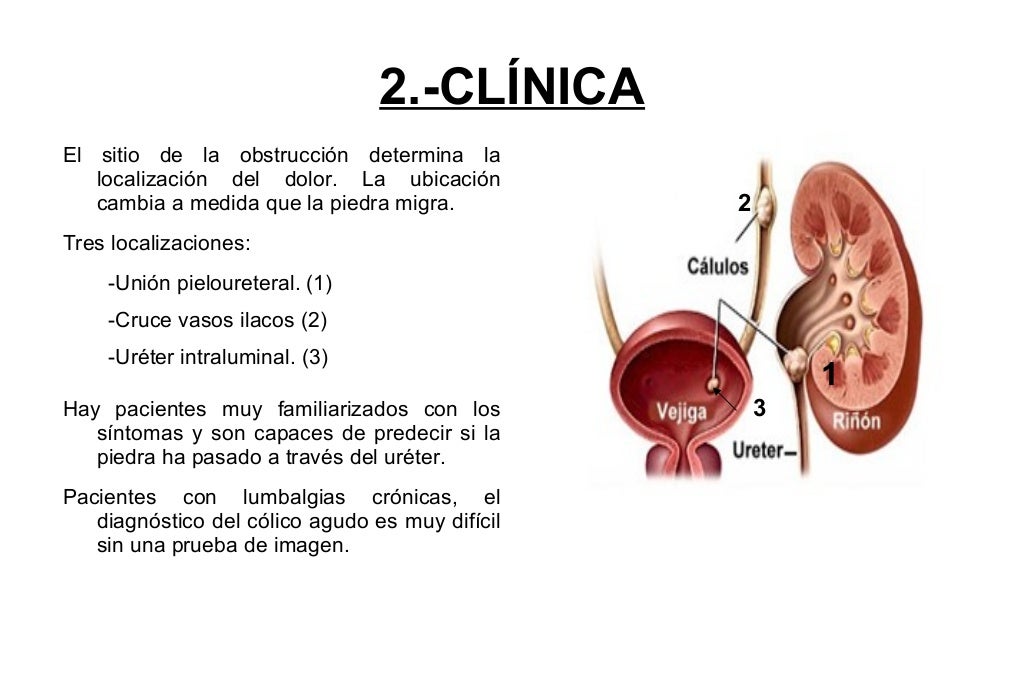 (2017-01-17) COLICO RENAL (PPT)