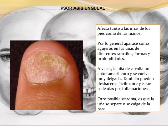 La psoriasis y los cuentagotas gemodez