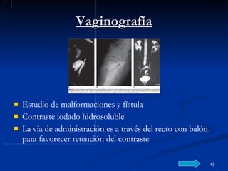 Vaginografía Estudio de malformaciones y fístula Contraste iodado hidrosoluble La vía de administración es a través del recto con balón para favorecer retención del contraste 