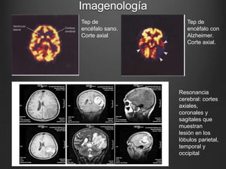 Imagenología 
Tep de 
encéfalo sano. 
Corte axial 
Tep de 
encéfalo con 
Alzheimer. 
Corte axial. 
Resonancia 
cerebral: cortes 
axiales, 
coronales y 
sagitales que 
muestran 
lesión en los 
lòbulos parietal, 
temporal y 
occipital 
 