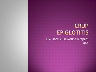 Crupepiglotitis IRM. Jacqueline Molina Tarapués HEG 
