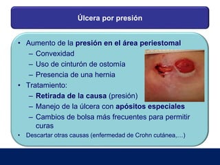 Úlcera por presión
• Aumento de la presión en el área periestomal
– Convexidad
– Uso de cinturón de ostomía
– Presencia de una hernia
• Tratamiento:
– Retirada de la causa (presión)
– Manejo de la úlcera con apósitos especiales
– Cambios de bolsa más frecuentes para permitir
curas
• Descartar otras causas (enfermedad de Crohn cutánea,…)
 