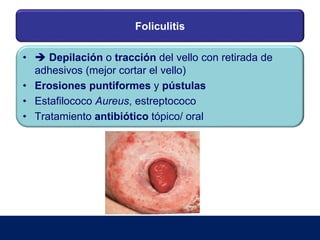 Foliculitis
•  Depilación o tracción del vello con retirada de
adhesivos (mejor cortar el vello)
• Erosiones puntiformes y pústulas
• Estafilococo Aureus, estreptococo
• Tratamiento antibiótico tópico/ oral
 