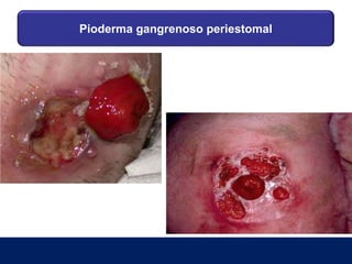 Pioderma gangrenoso periestomal
 