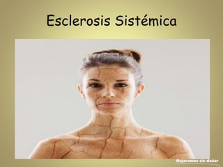 Esclerosis Sistémica
 
