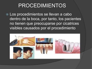 PROCEDIMIENTOS


Los procedimientos se llevan a cabo
dentro de la boca, por tanto, los pacientes
no tienen que preocuparse por cicatrices
visibles causados por el procedimiento

 