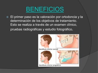 BENEFICIOS


El primer paso es la valoración por ortodoncia y la
determinación de los objetivos de tratamiento.
Esto se realiza a través de un examen clínico,
pruebas radiográficas y estudio fotográfico.

 