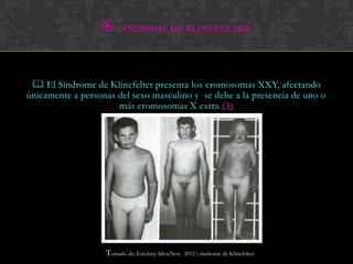  SÍNDROME DE KLINEFELTER


  El Síndrome de Klinefelter presenta los cromosomas XXY, afectando
únicamente a personas del sexo masculino y se debe a la presencia de uno o
                      más cromosomas X extra.(3)




                   Tomado de: Estefany Silva(Nov.   2012 ) síndrome de Klinefelter
 