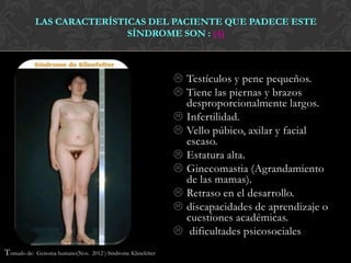 LAS CARACTERÍSTICAS DEL PACIENTE QUE PADECE ESTE
                             SÍNDROME SON : (4)



                                                               Testículos y pene pequeños.
                                                               Tiene las piernas y brazos
                                                                desproporcionalmente largos.
                                                               Infertilidad.
                                                               Vello púbico, axilar y facial
                                                                escaso.
                                                               Estatura alta.
                                                               Ginecomastia (Agrandamiento
                                                                de las mamas).
                                                               Retraso en el desarrollo.
                                                               discapacidades de aprendizaje o
                                                                cuestiones académicas.
                                                               dificultades psicosociales
Tomado de:   Genoma humano(Nov. 2012 ) Síndrome Klinefelter
 