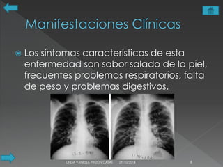  Los síntomas característicos de esta 
enfermedad son sabor salado de la piel, 
frecuentes problemas respiratorios, falta 
de peso y problemas digestivos. 
LINDA VANESSA PINZÓN CASAS 29/10/2014 6 
 