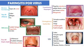 Faringitis, patologías de otorrinolaringología | PDF