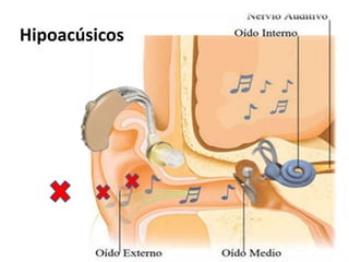 HipoacúsicosHipoacúsicos
 