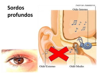 Sordos
profundos
 