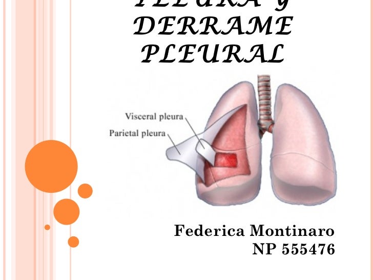 Derrame pleural
