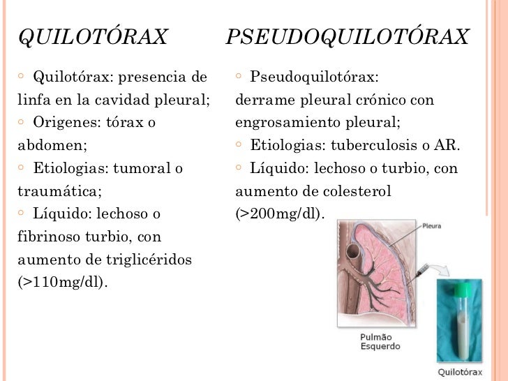 Derrame pleural