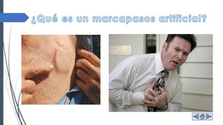 Síntomas Cirugía
 Visión borrosa
 Dificultad para respirar
 Mareos
 Dolor en el pecho
 Se considera una cirugía
menor.
 Los cables de un marcapasos son
enroscados a través de una vena
grande al corazón y el generador
es insertado bajo la piel y
conectado a los cables.
 Solo dura unas horas y una
noche en recuperación.
 