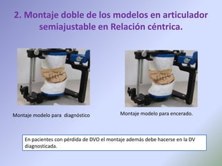 2. Montaje doble de los modelos en articulador
     semiajustable en Relación céntrica.




Montaje modelo para diagnóstico            Montaje modelo para encerado.



    En pacientes con pérdida de DVO el montaje además debe hacerse en la DV
    diagnosticada.
 
