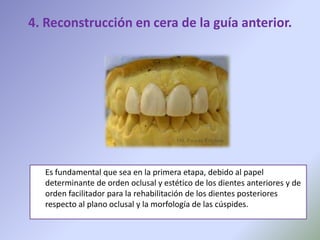 4. Reconstrucción en cera de la guía anterior.




  Es fundamental que sea en la primera etapa, debido al papel
  determinante de orden oclusal y estético de los dientes anteriores y de
  orden facilitador para la rehabilitación de los dientes posteriores
  respecto al plano oclusal y la morfología de las cúspides.
 