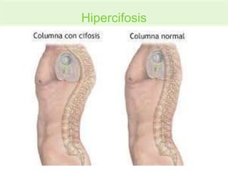 Hipercifosis