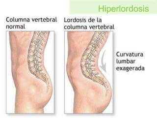 Hiperlordosis
