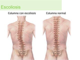 Escoliosis